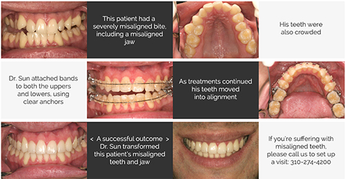 Complex Orthodontic Treatment
