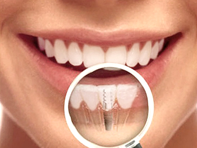 Dental Implants - A permanent solution to missing or damaged teeth (Click or Tap anywhere to close window)