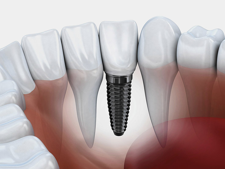 Dental Implants