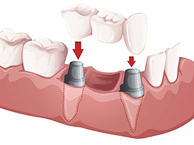 Bridges, Caps and Crowns - We offer several procedures that utilize our in-house lab