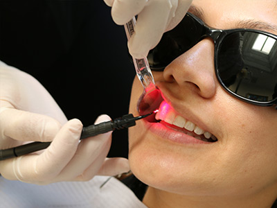 Laser dentistry provides a minimally-invasive alternative to traditional surgical procedures, resulting in an efficient and pain-minimizing experience. Lasers are also used for theraputic post-op healing. Lasers can even be used to promote healing for canker sores and herpes (Click or Tap anywhere to close window)
