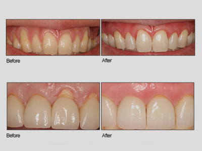 Patients of Dr. Grace Sun who are interested in fixing their receding gums permanently but are looking for a gum grafting alternative will be pleased to know that she performs the Pinhole Surgical Technique (PST™) on appropriate candidates. This revolutionary type of gum recession surgery enables people to completely solve their gum recession without the need for incisions or sutures (Click or Tap anywhere to close window)