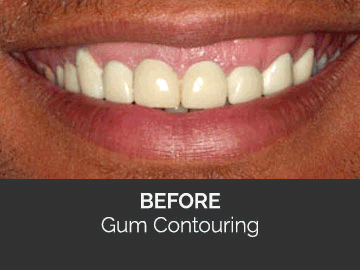 Gum contouring Before & After case
