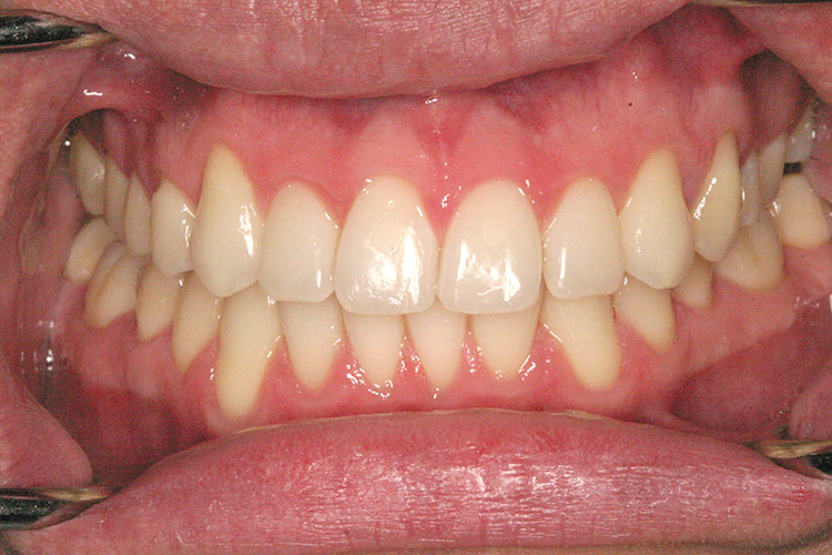 A successful outcome. Dr. Sun transformed this patient's misaligned teeth and jaw (tap screen to close)