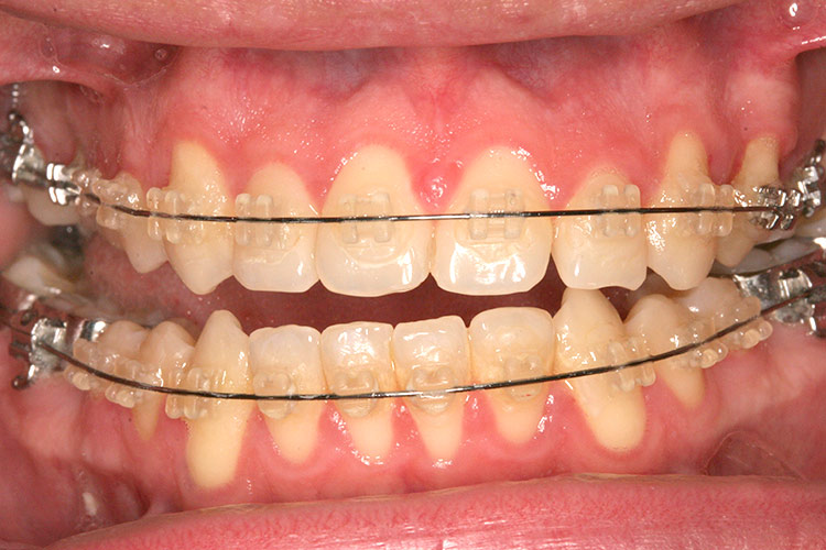 Dr. Sun attached bands to both the uppers and lowers, using clear anchors.(tap screen to close)