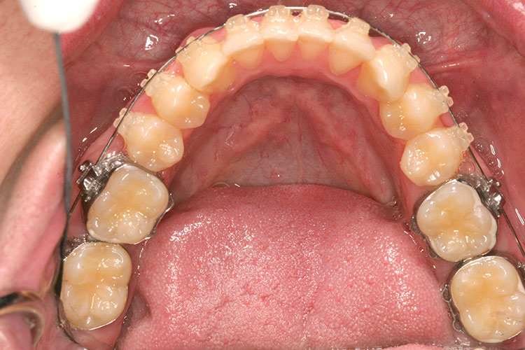 As treatments continued, his teeth moved into alignment. (tap screen to close)