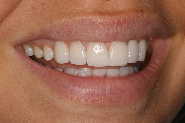 Our patient's smile looks great from all angles. (tap screen to close)