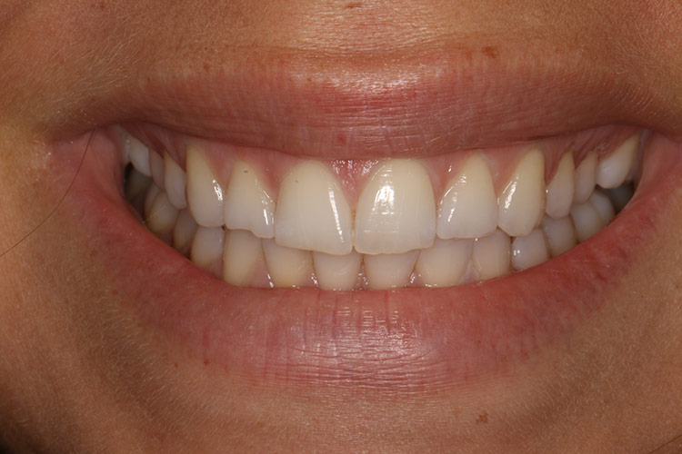 Here's how her smile looked when she first began the process of getting veneers. (tap screen to close)