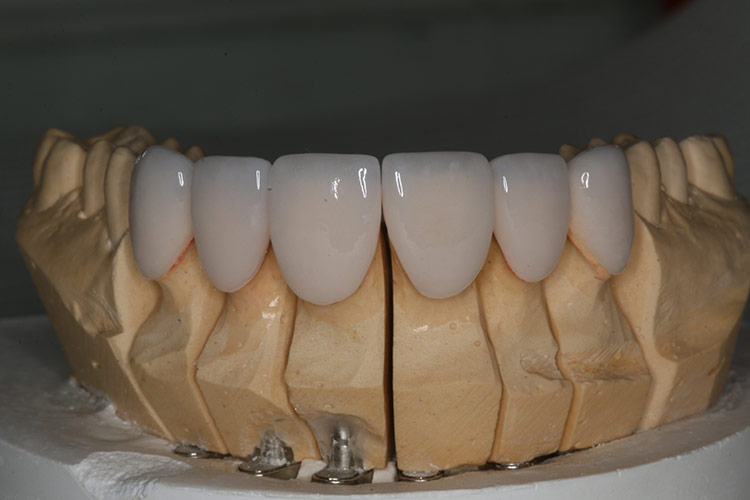 Dr. Sun worked along side our lab technician to color and shape her veneers. (tap screen to close)