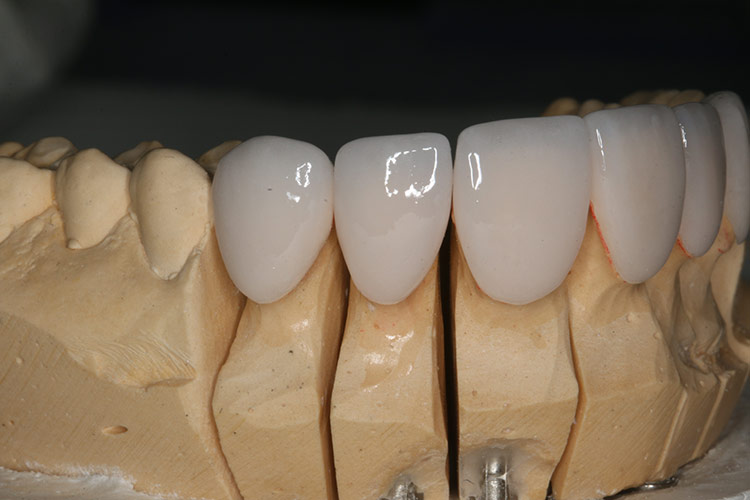 We fit the veneers onto a mold of her teeth, to assure the correct fit. (tap screen to close)
