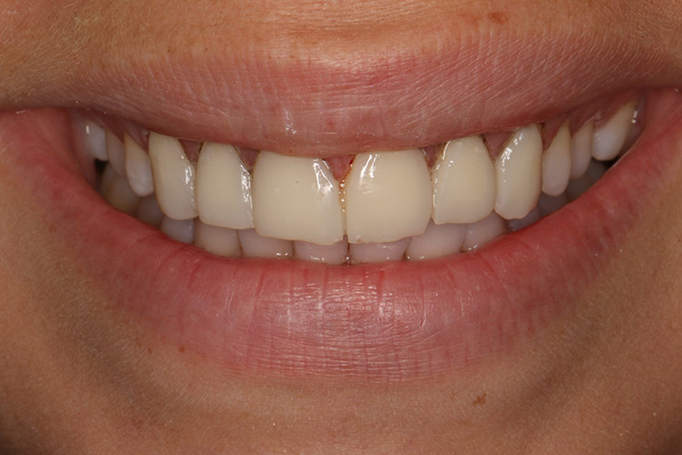 Our patient was fitted with a set of temporary veneers while we finished up the final set. (tap screen to close)