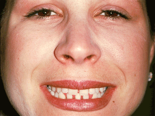 Nicole had unusually large gaps between her front teeth, both top and bottom. The solution: All of Nicole's upper and lower front teeth were bonded, distributing the needed bulk evenly to achieve a natural-looking smile (Click or Tap anywhere to close window)