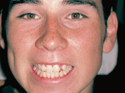 Michael had one of his top front teeth hidden from view on his palate. Plus, his other teeth were crooked. The solution: Michael's problem was corrected with braces, to straighten out his teeth (Click or Tap anywhere to close window)